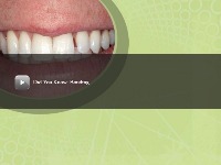 Cosmetic Dental Bonding video thumbnail image