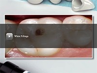 White Fillings video thumbnail image